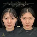 糸リフト・あごヒアルロン酸 before画像 サムネイル用