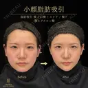 脂肪吸引注射（頬・口横・エラ下・顎下）・あごヒアルロン酸 31日後 サムネイル用