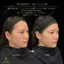 脂肪吸引注射（頬・口横・エラ下・顎下）・あごヒアルロン酸 before画像 サムネイル用