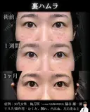 裏ハムラ 30日後 サムネイル用