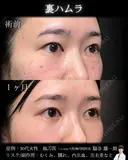 裏ハムラ 30日後 サムネイル用