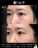 裏ハムラ 30日後 サムネイル用