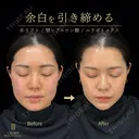 糸リフト・あごヒアルロン酸・エラボトックス 31日後 サムネイル用