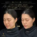 糸リフト・あごヒアルロン酸・エラボトックス before画像 サムネイル用