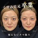 切らないクマ取り・目の下ヒアルロン酸 31日後 サムネイル用