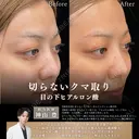 切らないクマ取り・目の下ヒアルロン酸 before画像 サムネイル用