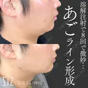【ミニ脂肪吸引】溶解注射で8回で微妙… after画像 サムネイル用