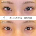 タレ目+目尻切開 14日後 サムネイル用