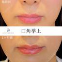 口角挙上 before画像 サムネイル用