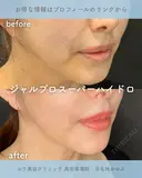 ジャルプロスーパーハイドロ after画像 サムネイル用