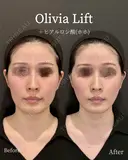 Olivia Lift after画像 サムネイル用