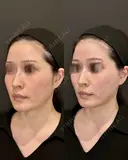 Olivia Lift after画像 サムネイル用