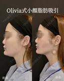 Olivia式小顔脂肪吸引 before画像 サムネイル用