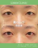 裏ハムラ術後1ヶ月 before画像 サムネイル用