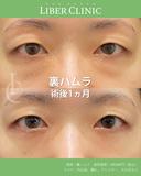 裏ハムラ術後1ヶ月 after画像 サムネイル用