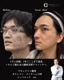 ニキビ治療 before画像 サムネイル用
