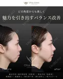 鼻尖形成＋鼻中隔延長（肋軟骨）・貴族手術（肋軟骨） 鼻翼縮小・鼻翼挙上・鼻孔縁下降・鼻孔縁挙上・顎プロテーゼ before画像 サムネイル用