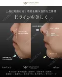鼻尖形成＋鼻中隔延長（肋軟骨）・貴族手術（肋軟骨） 鼻翼縮小・鼻翼挙上・鼻孔縁下降・鼻孔縁挙上・顎プロテーゼ 90日後 サムネイル用
