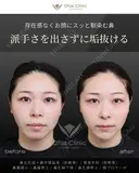鼻尖形成＋鼻中隔延長（肋軟骨）・貴族手術（肋軟骨） 鼻翼縮小・鼻翼挙上・鼻孔縁下降・鼻孔縁挙上・顎プロテーゼ before画像 サムネイル用