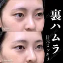 裏ハムラ 180日後 サムネイル用