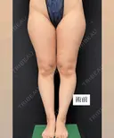 シークレット脂肪吸引脚まわり before画像 サムネイル用