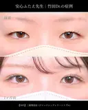 二重埋没法(クイックシンデレラ・トリプル) before画像 サムネイル用