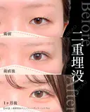 二重埋没法(クイックシンデレラ・トリプル) 30日後 サムネイル用