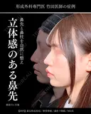 鼻尖形成3D法/軟骨移植/鼻柱下降術/MD式 90日後 サムネイル用