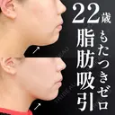 ベイザー併用アキーセル脂肪吸引＋糸リフト＋エンブレイスRF before画像 サムネイル用