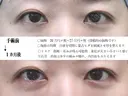 目頭切開法 30日後 サムネイル用