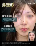 【鼻整形】鼻尖形成3D法＋耳介軟骨移植＋小鼻縮小 内側法・引き締め縫合 before画像 サムネイル用