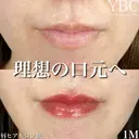 【🌟唇ヒアルロン酸🌟】 after画像 サムネイル用