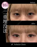 ⭐DR都築⭐二重埋没 before画像 サムネイル用