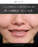 人中短縮（鼻孔内切開） 90日後 サムネイル用