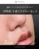 人中短縮（鼻孔内切開） 90日後 サムネイル用