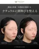 人中短縮（鼻孔内切開） before画像 サムネイル用