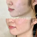 加賀デザイン×バッカルファット除去 before画像 サムネイル用