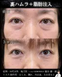 裏ハムラ・脂肪注入 before画像 サムネイル用