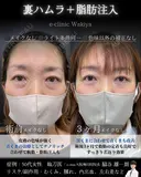 裏ハムラ・脂肪注入 90日後 サムネイル用