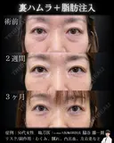 裏ハムラ・脂肪注入 90日後 サムネイル用