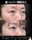 裏ハムラ・脂肪注入 90日後 サムネイル用