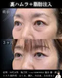 裏ハムラ・脂肪注入 90日後 サムネイル用