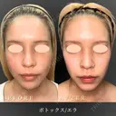 エラボトックス 60日後 サムネイル用
