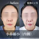 小鼻縮小 before画像 サムネイル用