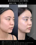 【鼻整形】鼻尖形成3D法＋耳介軟骨移植＋鼻柱下降＋プロテーゼ after画像 サムネイル用