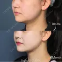 アキーセル脂肪吸引｜フェイスライン（頬＋顎）　術後インディバ付き after画像 サムネイル用