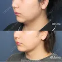 アキーセル脂肪吸引｜フェイスライン（頬＋顎）　術後インディバ付き before画像 サムネイル用