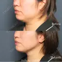 アキーセル脂肪吸引｜フェイスライン（頬＋顎）　術後インディバ付き before画像 サムネイル用