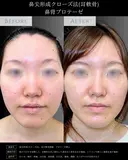 【鼻整形】鼻尖形成クローズ法＋耳介軟骨移植 after画像 サムネイル用