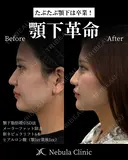 ⭐DR都築⭐小顔カスタマイズ after画像 サムネイル用